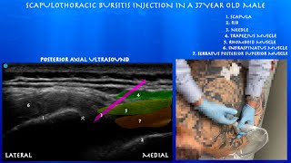 Ultrasound Guided Scapulothoracic Bursa Injection by probeultrasound [upl. by Leoy174]