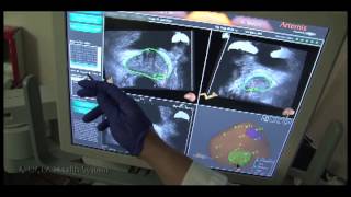 11 MRUS Fusion Guided Prostate Biopsies Technical Discussion [upl. by Baudelaire]