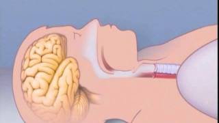 What Is Sleep Apnea [upl. by Fusco130]