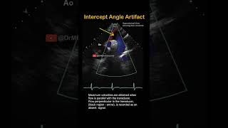 Intercept Angle Artifact on Echocardiography echocardiogram echo ultrasound ARDMS [upl. by Columbine742]