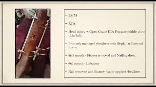 Revision Ilizarov fixation for Open grade IIIA fracture shaft tibia [upl. by Oranneg717]