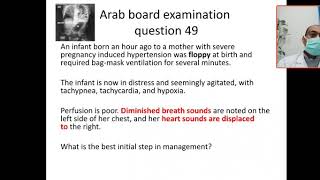 MCQ 49 CDH diaphragmtic hernia scaphoid abdomen mediastinal shift [upl. by Francene]