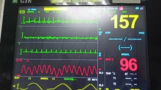 AF Atrial Fibrillation In ECG icu cardiombbsmedicalstudentheartshareyoutube [upl. by Wandie]