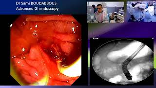 ERCP for acute cholangitis [upl. by Baumann]