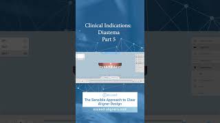 Clinical Indications Diastema Part 5 [upl. by Randell]