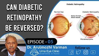 Diabetes Retinopathy  Can Diabetic Retinopathy Be Reversed  Dr Arulmozhi Varman  EPI 05 [upl. by Ecirb209]