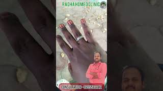 Wart remover in tamil wart remover ointment review wart remover ointment warts Radha homeo clinic [upl. by Zetniuq]