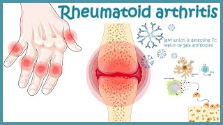 Rheumatoid Arthritis  autoimmune disorder  Pathophysiology risk factors treatment [upl. by Ahsinrac104]