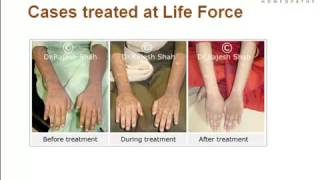 Oral Lichen Planus Treatment  लाइकेन प्लानस का इलाज  Best Homeopathic Doctor [upl. by Ynoyrb712]