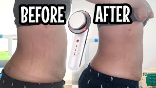 Ultrasonic Fat Cavitation Before And After  Fat Cavitation Before And After Results  AMAZING [upl. by Grace]