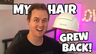 MY HAIR GREW BACK 6 months using iRestore Laser Hair Growth Therapy [upl. by Nehgem]