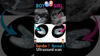 Ultrasound  baby boy v baby girl ultrasound pregnancy babyboy [upl. by Ophelie585]