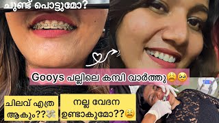 കൊള്ളാമോ😩കമ്പി വാർക്കൽ Day Braces journey🦷Sharing Experience🥵 braces story viral vlog journey [upl. by Diarmid]