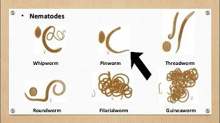 Pinworms Threadworm Infection [upl. by Averell]