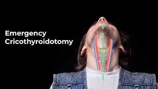 Performing an Emergent Cricothyroidotomy  MEDZCOOL [upl. by Hanford]