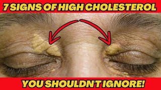 7 Signs of High Cholesterol You Shouldnt Ignore [upl. by Anhoj]