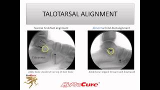 Guide to Misaligned and Flat feet [upl. by Cairistiona]