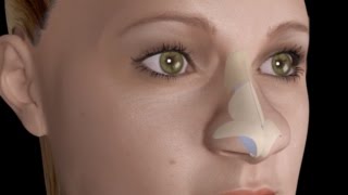 Bulbous Large Nasal Tip Nose Job Rhinoplasty [upl. by Elkraps]