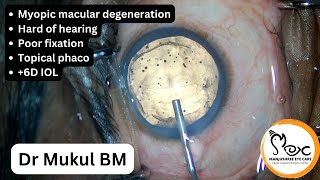 Myopic macular degen Topical phaco  6D IOL [upl. by Walston837]