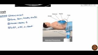 Ascites for USMLE Step 2 [upl. by Nylrats]