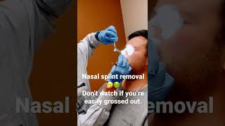 Nasal splint removal septoplasty [upl. by Ardnaeel492]