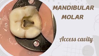 Access opening of Mandibular Molar [upl. by Aytac]