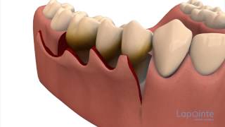 Periodontal flap approach surgery  Lapointe dental centres [upl. by Solenne]