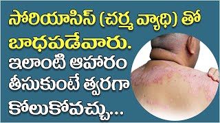 Psoriasis  Psoriasis Treatment amp Food diet in Telugu  Skin Disease Solution in Ayurveda [upl. by Fiertz]