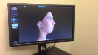 Rhinoplasty and the VECTRA 3D Imaging System [upl. by Acinorav905]