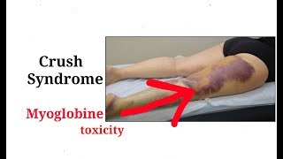 Crush syndrome  rhabdomyolysis  Muscles injuryHindi [upl. by Neelahtak]