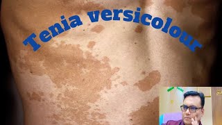 Tinea versicolour treatment Tinea versicolour causes fungal [upl. by Akissej]