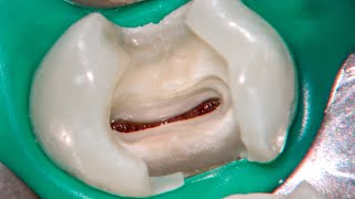 DRendo  Partial pulpotomy in two maxillary premolars [upl. by Crowns]