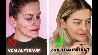 ❗️ In NUR 3 Monaten zur TRAUMHAUT  HEFTIGES Ergebnis ❗️ Microneedling Vorher Nachher Diana Delo [upl. by Michella]