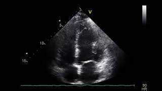 Severe Akinesia of Right Ventricular Wall Septum Left Ventricular Wall and Apex [upl. by Paxton]