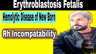 Erythroblastosis fetalis  Rh Incompatibility  Hemolytic Disease of New Born [upl. by Lessur294]