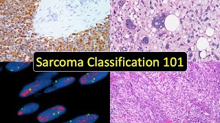 Sarcoma Classification 101 Soft Tissue Tumor Naming Made Simple for Beginners amp NonPathologists [upl. by Yrdua]