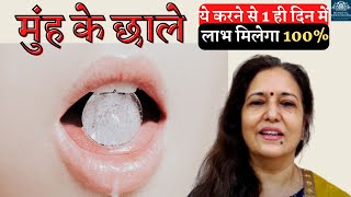 आधा मिनट ये मुँह में रखें  असर देखें  Best घरेलू उपचार  Mouth Ulcer home remedy  Madhu Choudhary [upl. by Lama]