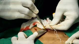 Open Appendectomy  Live surgical video [upl. by Dnomyaw398]