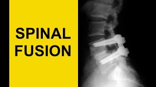 Lumbar Spinal Fusion Surgery AVOID Adjacent Segment Disease [upl. by Selma]