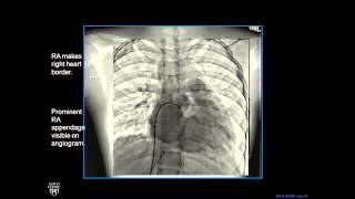 Plain Film Cardiac and Vascular Anatomy  Frontal Radiograph  Philip Araoz MD  Part 4 of 10 [upl. by Ivory590]