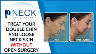 Minimally Invasive Neck Lift and Double Chin Treatment neckcontourplasty [upl. by Mairim558]