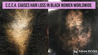 What is CCCA Central Centrifugal Cicatricial Alopecia is a Common Cause of Hair Loss in Black Women [upl. by Arabele]