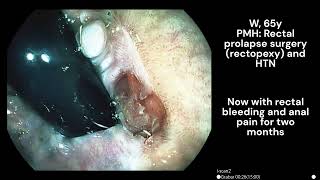 Anorectal Melanoma [upl. by Harness]