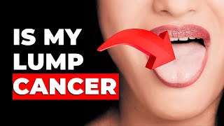 Doctor explains lumps CANCER or NOT [upl. by Rand]