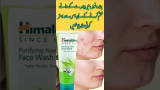 How to remove pimplesAcnepimplepoppingacneremedyskincarebeautytips [upl. by Rutherford730]