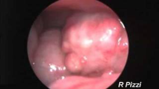 Endoscopy of a chicken with salpingitismp4 [upl. by Sibel]