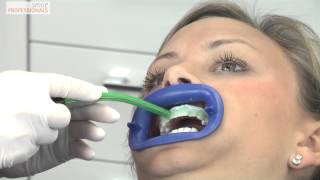 Weiße Zähne durch Bleaching  Zahnaufhellung  Zahnarzt Gundelfingen  Smile Professionals [upl. by Oneil]