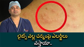 Polymorhous Light Eruption Symptoms and Causes  లైట్స్ వల్ల చర్మంపై ఎలర్జీలు వస్తాయా [upl. by Orgel]