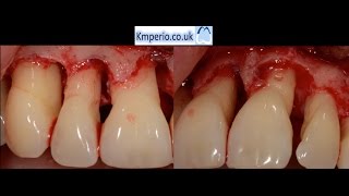 Periodontal Surgery with Regeneration for Upper Teeth [upl. by Divadleahcim]