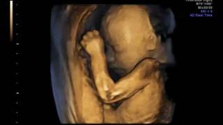 3D ultrasound 25 weeks 4D view of baby 25 week pregnancy baby girl first view [upl. by Fabyola]